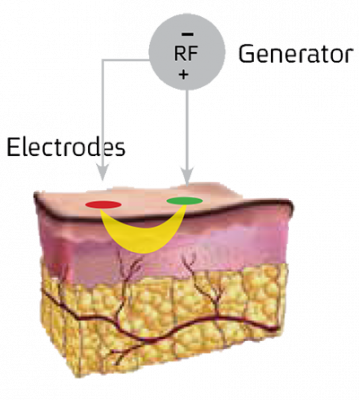 RF đa cực và RF lưỡng cực tác động nông và tương đối kém hiệu quả - vietanammed